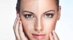 Learn More on How Facial Rejuvenation Can Make Your Skin Rejuvenated and Youthful